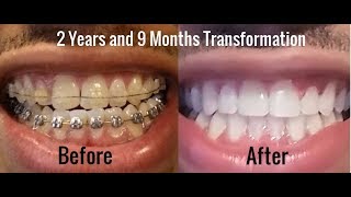 BEFORE & AFTER BRACES! | Very Bad Crossbite Correction!!