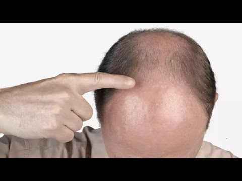 Best Male Or Female Pattern Baldness Treatments YouTube Awesome Male Or Female Pattern Baldness Treatments Best Male Or Female Pattern Baldness Treatments YouTube Awesome Male Or Female Pattern Baldness Treatments