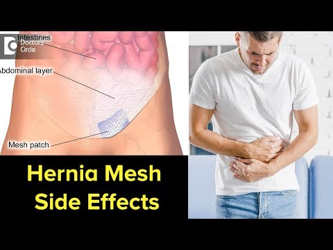 Can Hernia mesh cause problems years later? Signs, Symptoms, Treatment - Dr. Nanda Rajaneesh