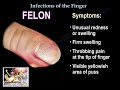 Infections Of The Finger - Everything You Need To Know - Dr. Nabil Ebraheim