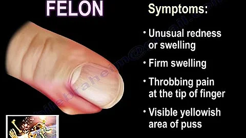 Infections Of The Finger - Everything You Need To Know - Dr. Nabil Ebraheim