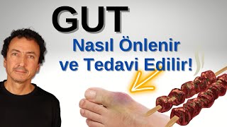 Gut Hakkındaki Gerçekler Nasıl Önlenir Ve Tedavi Edilir