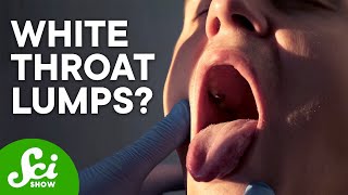 What Are Tonsil Stones & How Do I Get Rid of Them?