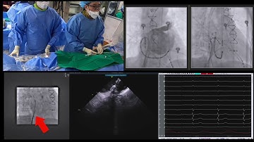 WATCHMAN #6  2nd trans septal puncture