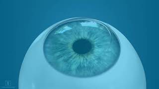 Optimized All Laser LASIK