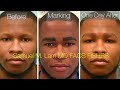 African Male FUE Eyebrow Transplant Testimonial One Day Out
