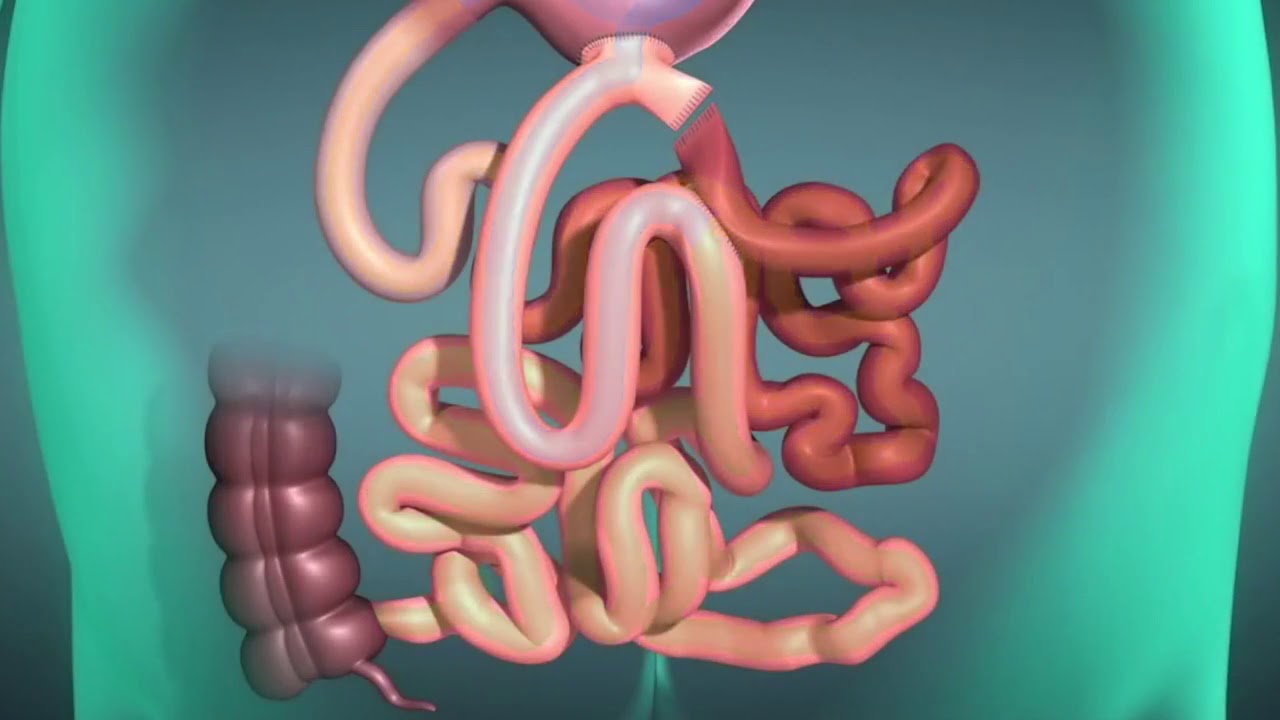 شرح مبسط لعملية الساسي مع دكتور أسامة خليل