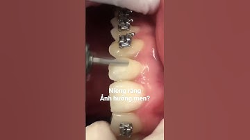 Niềng răng ảnh hưởng đến men răng như nào? #shorts #niengrang #menrang