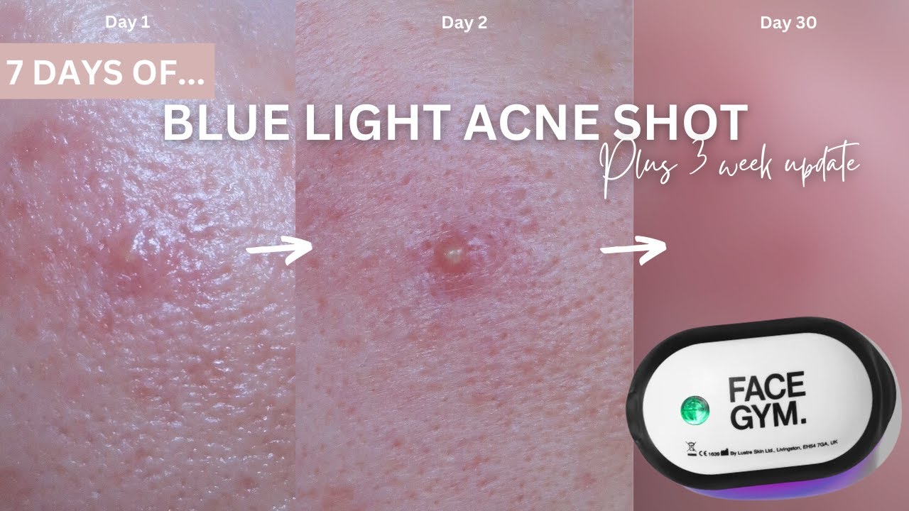 7 Days of Facegym Blue Light for Acne PLUS 3 WEEK UPDATE YouTube