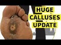 Huge Calluses Update: Still Working On These Diabetic Feet