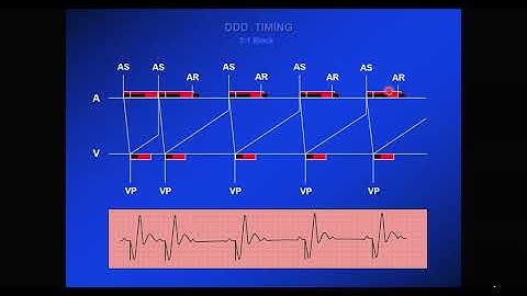 technical concepts and pacemaker timing cycles