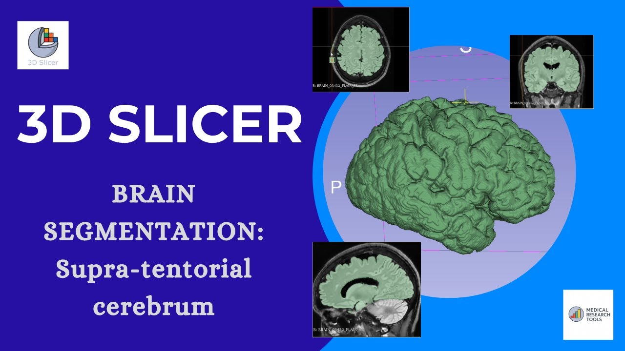 🧠Brain Segmentation with 3D Slicer: Supra-tentorial cerebrum