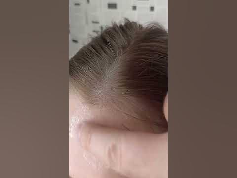 Как избавиться от прыщей на лице. Рабочий лайфхак - YouTube