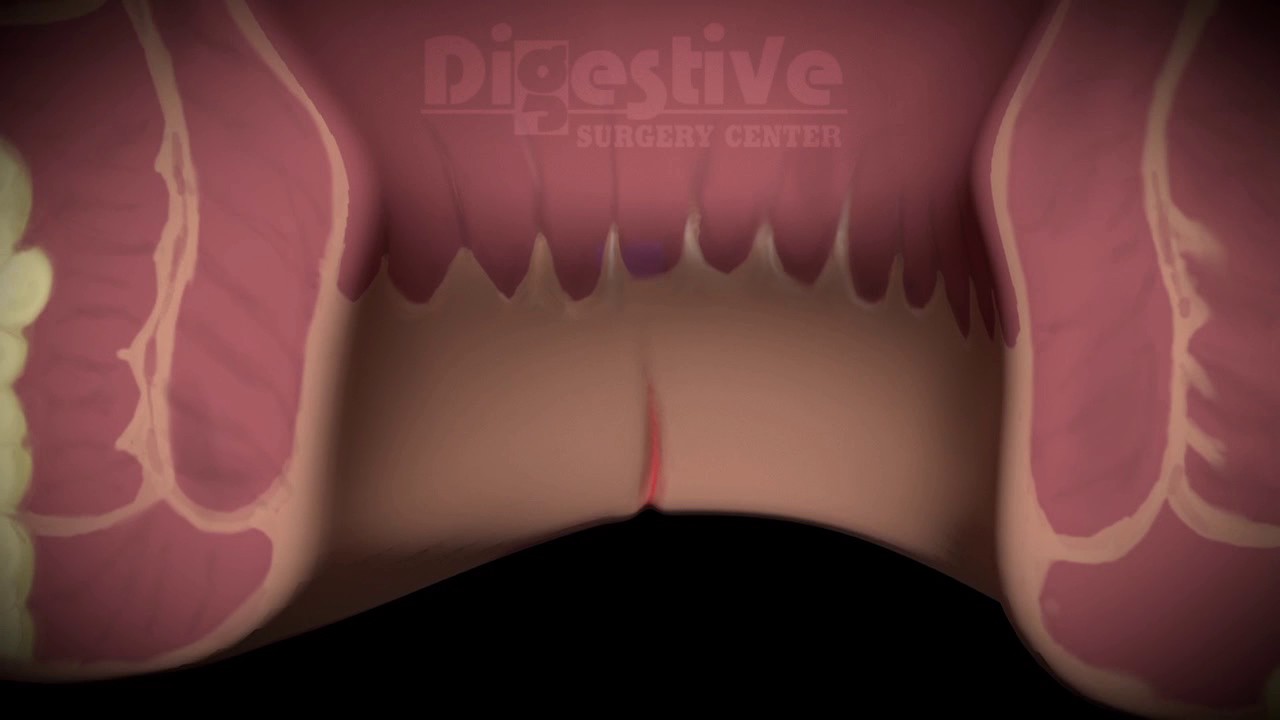 ANAL FISSURE VISUALIZATION - 3D ANIMATION - YouTube