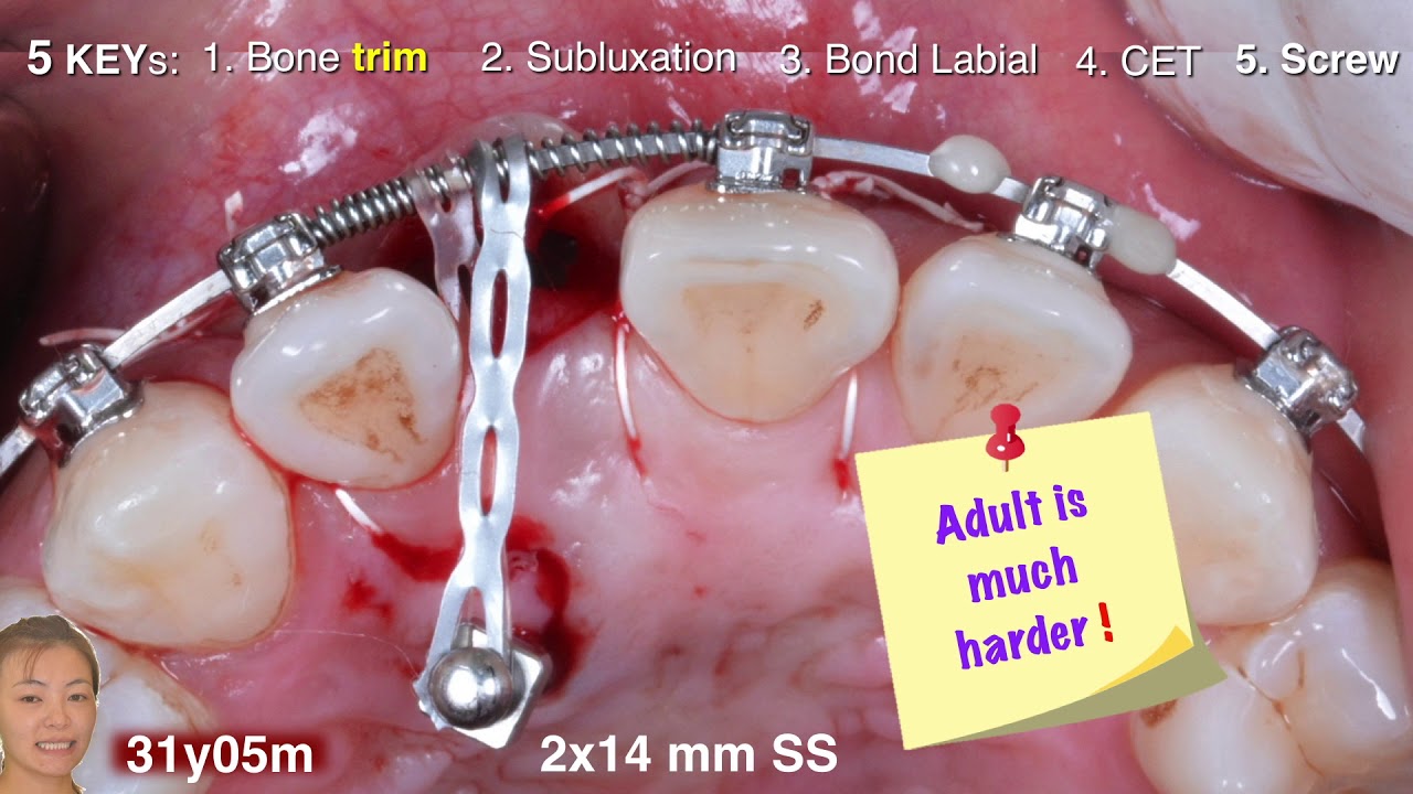 Innovative Impaction Treatment in AAO 2018 Part 4｜【Chris