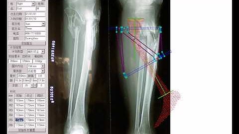 Two Step Fracture Alignment with Spatial Frame 3D
