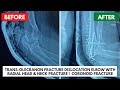 🔴 Trans-Olecranon Fracture Dislocation | Elbow Dislocation With Radial Head &amp; Neck Fracture 