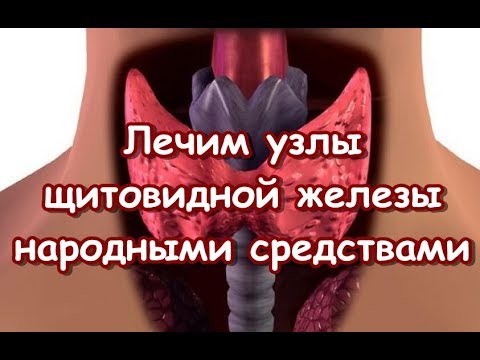 Лечим узлы щитовидной железы - народными средствами