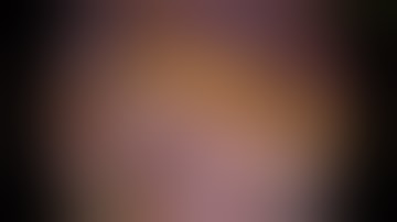 Laparoscopic Surgery  for Gastric GIST