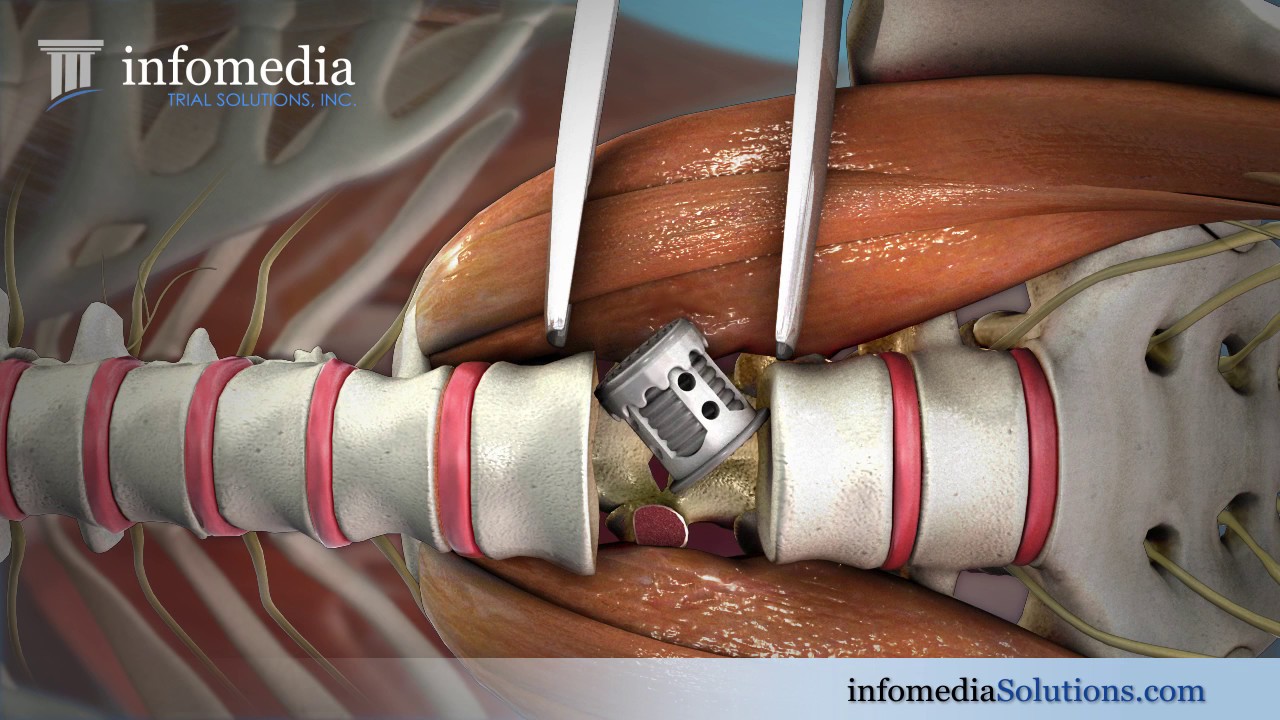 Lumbar Discectomy and Fusion - YouTube