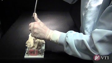 InterFuse S™ Insertion Technique