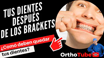 ¿Cómo deben quedar los dientes después de la ortodoncia?