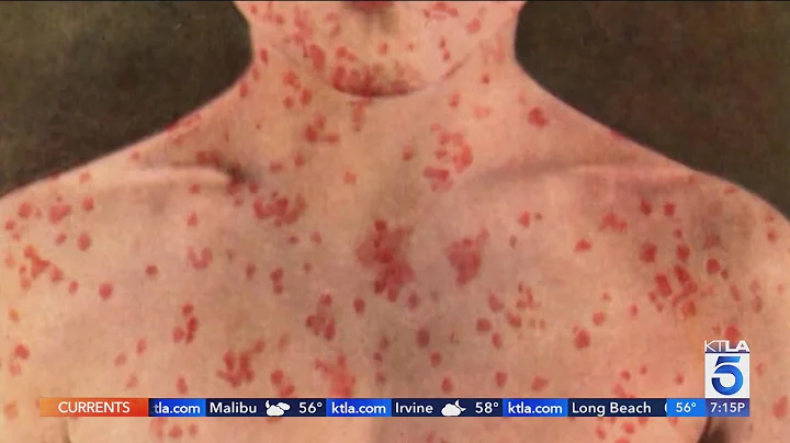 Deadly measles outbreak grows in West Texas