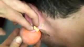 Давят громадный гнойник за ухом! Жесть! Давят громадный гнойник за ухом! Жесть!