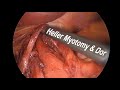 Heller Myotomy with Dor Fundoplication Surgical Footage and Animation for the Treatment of Achalasia