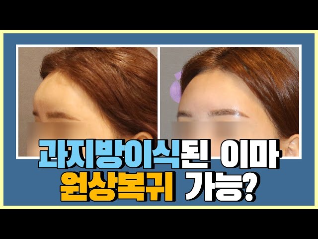 과주입 된 이마지방이식 부작용, 제거할 수 있을까?