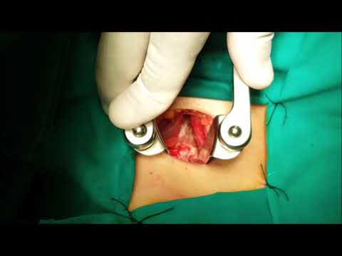 استئصال غضروف عنقي وتركيب قفص عنقي