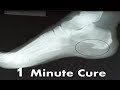 Plantar Fascia Heel Spur Pain [BEST Home Treatment & Remedies 2020!]