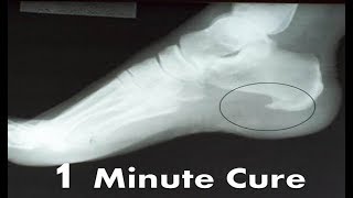 Plantar Fascia Heel Spur Pain [BEST Home Treatment \& Remedies!]