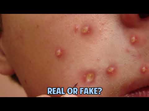 Worlds Greatest Medical Classic Pimples