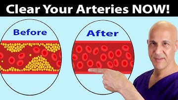 Eat These Foods to Clear Arteries FAST (Stop Heart Attacks & Strokes)  Dr. Mandell