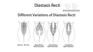 What Is a Diastasis and Can You Fix It?