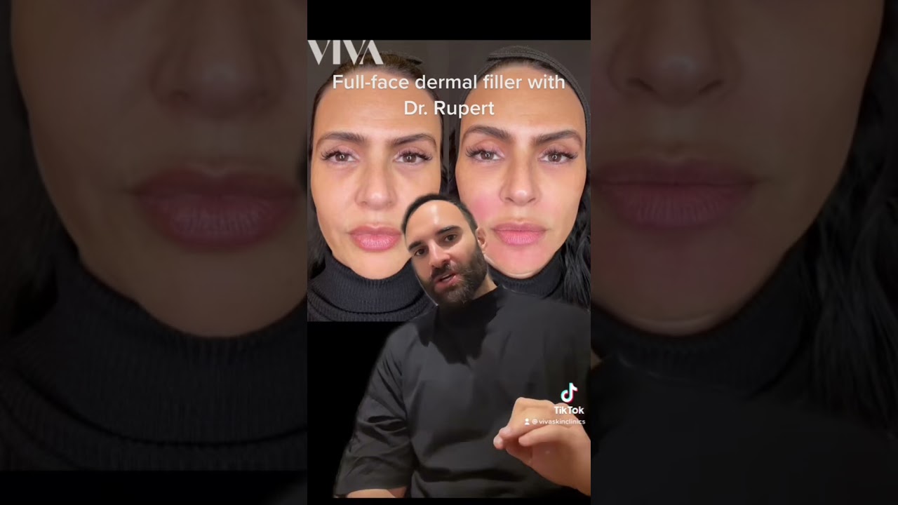 Full face #dermalfillers Dr Rupert case explained #fillers #beauty #jawlinefiller #antiaging