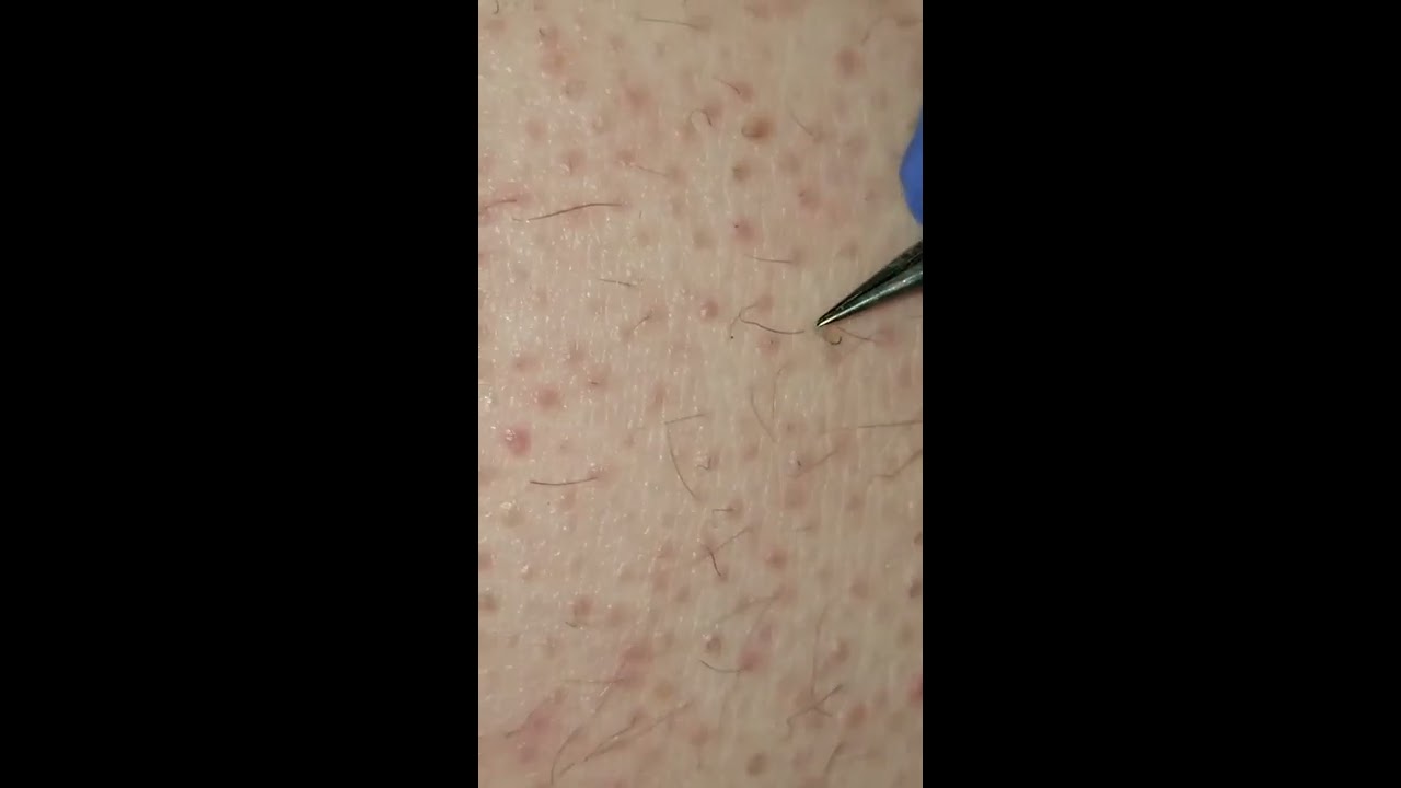 Endless plugs and ingrown hairs (My first video) Are these Keratin