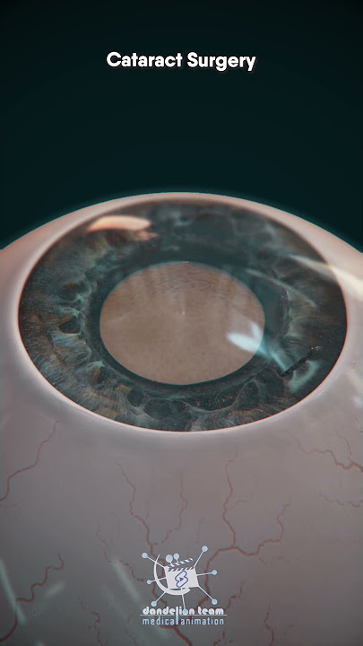 Clear Vision Again! Understanding Cataract Eye Surgery