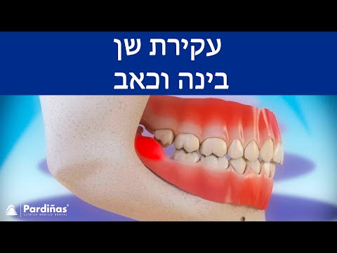 וִידֵאוֹ: כיצד לנקות את השיניים לאחר הסרת שיני בינה (עם תמונות)