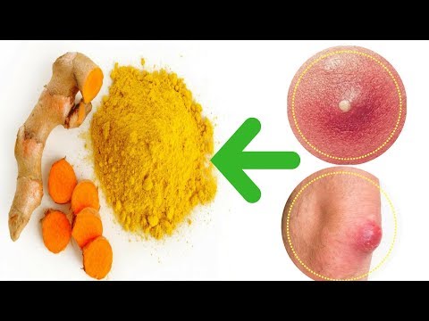 24 Ways To Use Turmeric for Boils