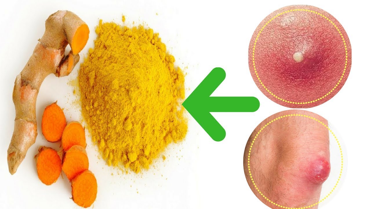 24 Ways To Use Turmeric For Boils Youtube