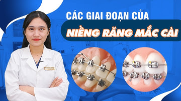 Các Giai Đoạn Của Niềng Răng Mắc Cài | Nam Bùi Vinalign