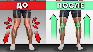 Х-образные колени (вальгус): как ИСПРАВИТЬ без операции?