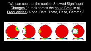 Science behind MAP - QEEG video