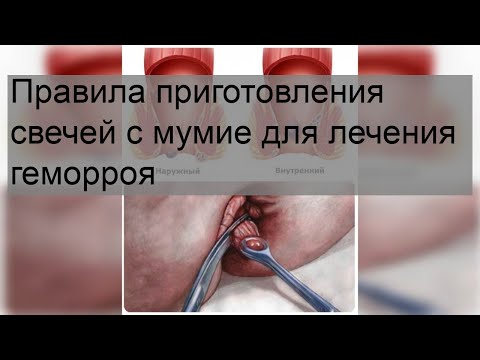 Правила приготовления свечей с мумие для лечения геморроя