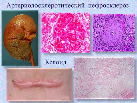 Патология - Лекция: Мезенхимальные и смешанные дистрофии.