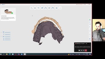3D Printed Splint Workflow
