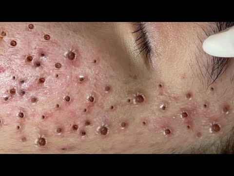 Loan Nguyen Acne Treatment 14999