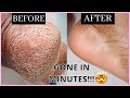 HOW TO REMOVE DEAD SKIN CELLS FROM YOUR FEET IN JUST 4 MINUTES | DR HENG SOY